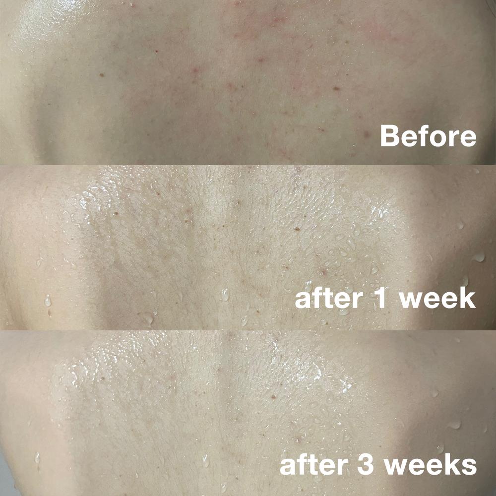 Red Acne Body Wash 4-pack Set