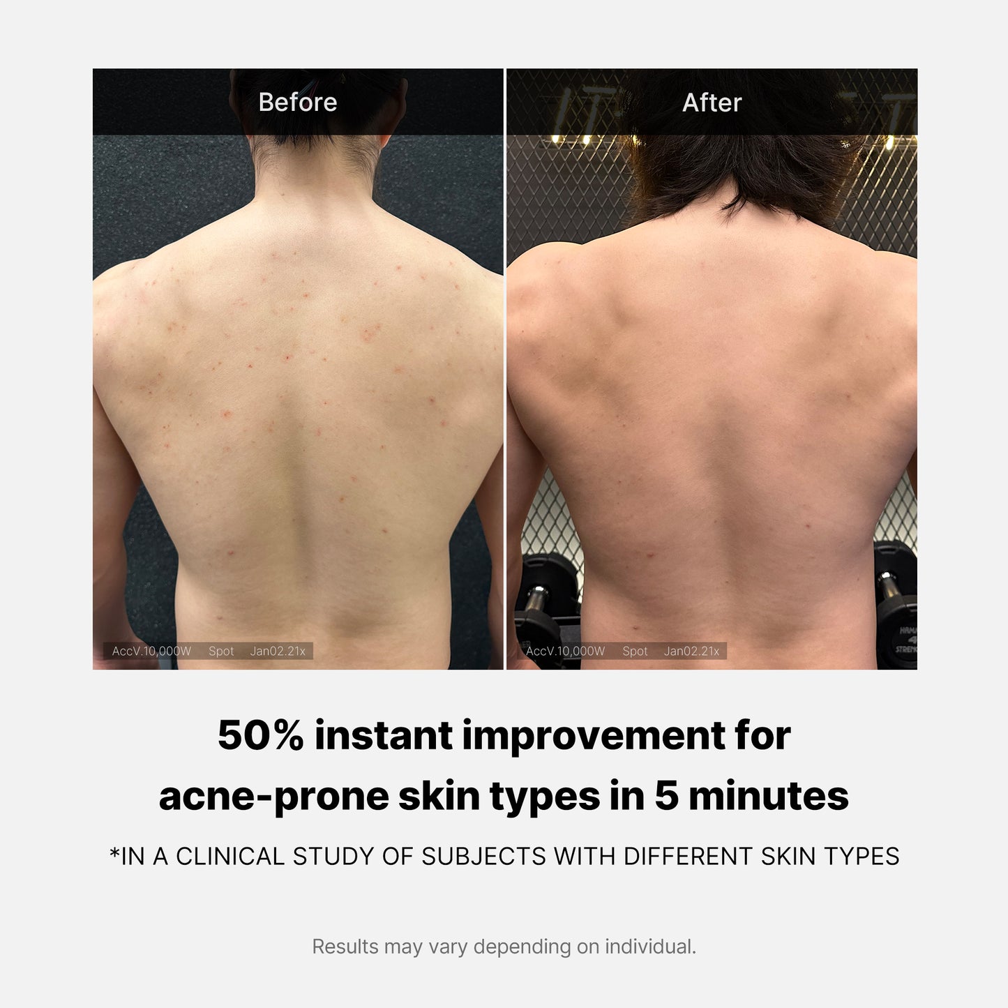 Red Acne Body Wash Duo Set